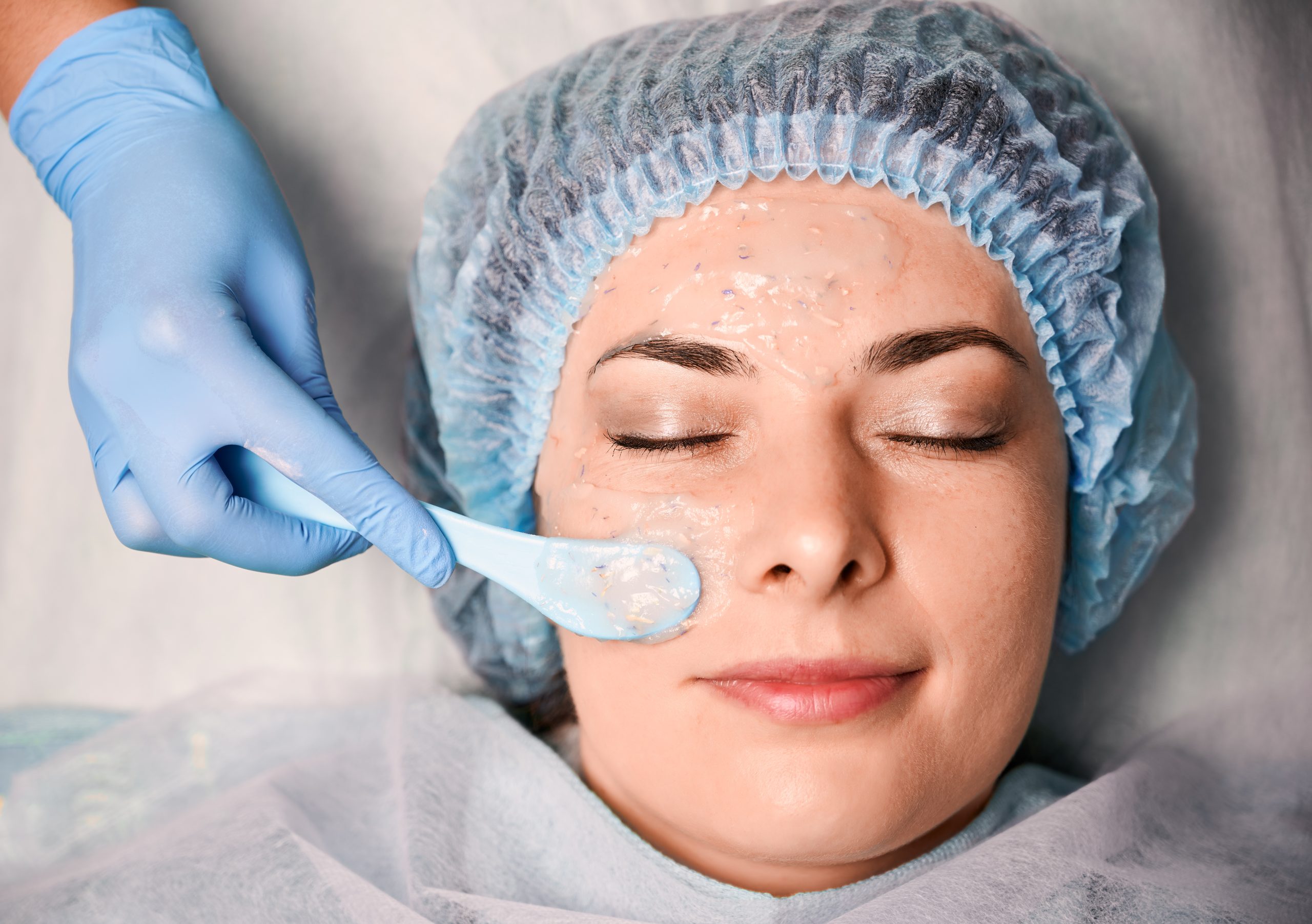 Chemical Peels